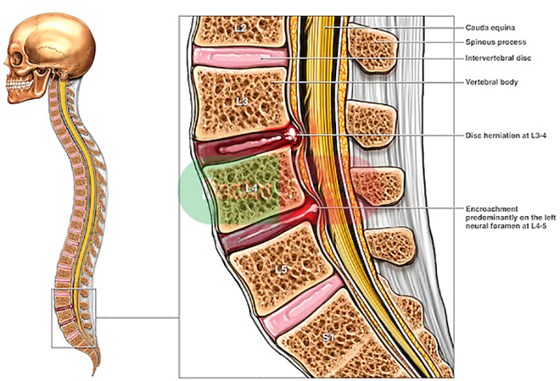 Triệu Chứng Của Thoát Vị Đĩa Đệm